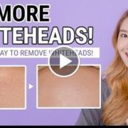 How To Remove Whiteheads, Small Bumps  Whitehead Removal to Prevention Care Routine
