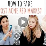 [Edited] How to Fade Post Acne Red Marks? Post Acne Skin Care Tips  My Acne Story  WWGY